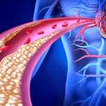 Breaking Down Hypercholesterolemia: Understanding Its Causes, Risks, and Management